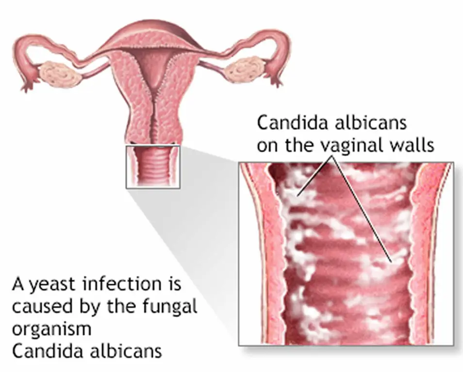 Gejala infeksi jamur pada vagina