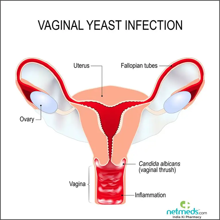 Gambar gejala infeksi vagina