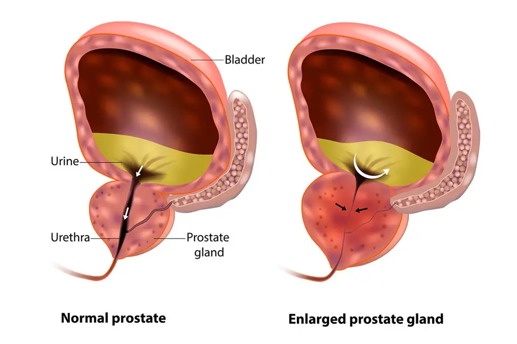 Gambar kelenjar prostat yang sehat