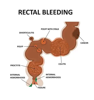 Gambar ilustrasi lendir rektum bercampur darah