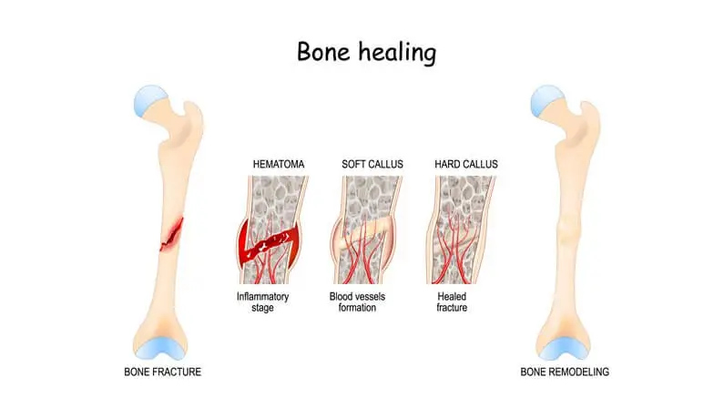 Proses penyembuhan tulang patah