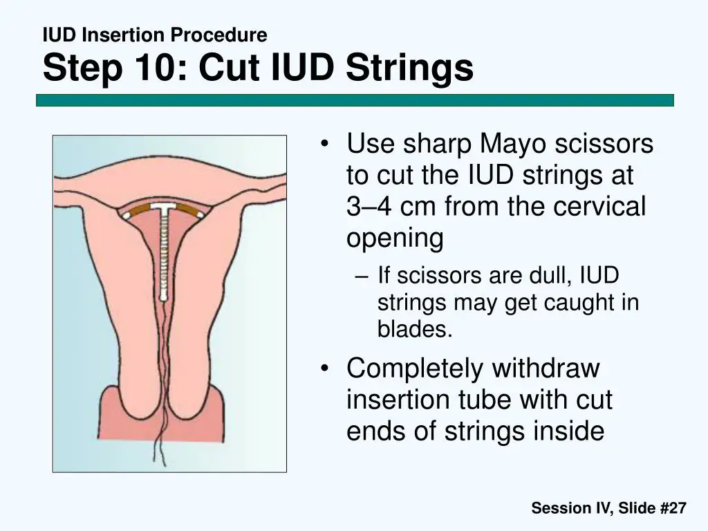 Ilustrasi prosedur pemasangan IUD