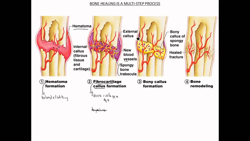 Ilustrasi proses penyembuhan patah tulang